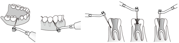 Сфера применения наконечника для скалера